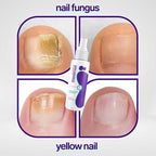 Jaysuin - Nail Fungus Spray (Original) جايسوين - بخاخ فطريات الأظافر (النسخة الأصلية)  🔥