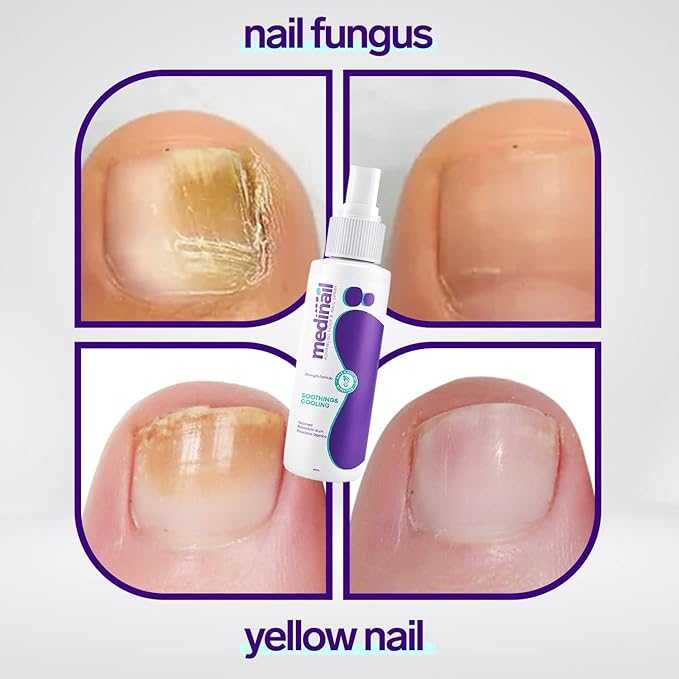 Jaysuin - Nail Fungus Spray (Original) جايسوين - بخاخ فطريات الأظافر (النسخة الأصلية)  🔥