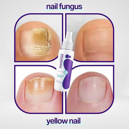 Jaysuin - Nail Fungus Spray (Original) جايسوين - بخاخ فطريات الأظافر (النسخة الأصلية)  🔥